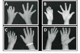 Poland syndrome was named for the investigator (poland a) who initially described the condition in 1841. Figure 2 From Presentation And Treatment Of Poland Anomaly Semantic Scholar