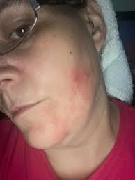 Does this look like it's healing ok? I'm guessing red rash is from the  bandages I had on. Day 4❤️