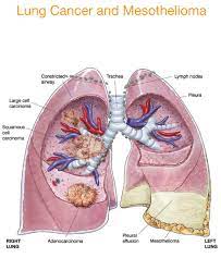 This can affect the organs in the abdomen, and its symptoms are related to this area of the. Serious Risk Of Lung Cancer Caused From Asbestos Exposure Mesothelioma 2020