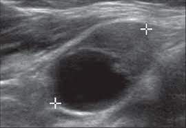 It can further evaluate the results of your mammogram for cancerous changes. Year Old Woman With Level Ii Metastatic Lymph Nodes In Left Neck Download Scientific Diagram