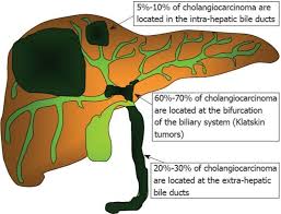 Cholangiocarcinoma Bile Duct Medical Medical Students
