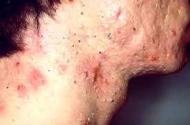 Severe recalcitrant nodular acne, which in the opinion of the investigator is compatible with isotretinoin treatment. Acne Vulgaris Pimples Cystic Acne