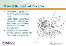 Delay of placental birth may cause severe, fatal hemorrhaging. Manual Removal Of Placenta Video Download Ebook And Manual Free