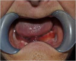 Image result for Trismus