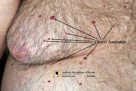 It is a true capillary haemangioma. Cherry Angioma Senile Angioma Academic Dermatology Of Nevada