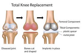 Most patients undergoing total knee replacement surgery want to know when they'll be able to return. Total Knee Replacement Surgery Mount Elizabeth Hospitals
