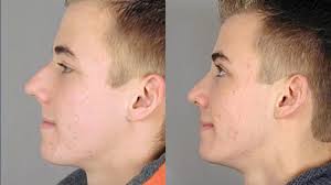 Male Rhinoplasty: George's Nose Job Experience & Unexpected Benefits  (Updated 2024)