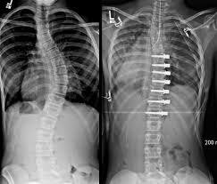How to fix the worst posture mistakes. Rope Or Rod Torn Between Scoliosis Surgery Whyy