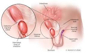 Image result for Inguinal hernia child