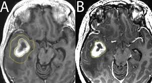 brain tumors are usually detected through imaging anatomical techniques such as magnetic resonance imaging (mri) and computed tomography (ct), and these imaging tests are usually performed if a patient displays the symptoms associated with brain tumors. Quantitative Mri Using Relaxometry In Malignant Gliomas Detects Contrast Enhancement In Peritumoral Oedema Scientific Reports
