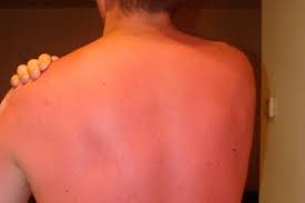 Image result for Sunburn