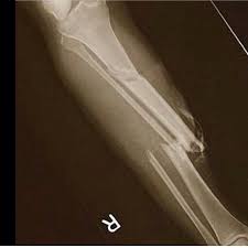 It started off decently enough, with george connecting the reaction to rice's violent episode to police violence. Nba Central On Twitter An X Ray Of Paul George S Leg Http T Co Cqnzkwdry3
