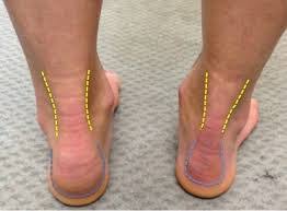 Achilles tendonitis heel drop exercises have proven to be very successful for chronic achilles tendon pain. Suffering From Achilles Tendinopathy Put Your Feet In Our Hands