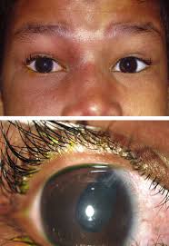 Intraocular Pressure Change in Orbital Disease