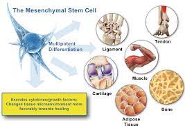 Stem Cell Prolotherapy Improves Pain Of Knee Osteoarthritis A Case Series