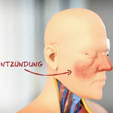 They might flare up for a few weeks, fade, and then come back. Rosazea Erkennen Und Behandeln Ndr De Ratgeber Gesundheit