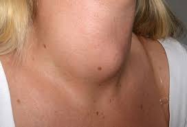The early signs of mouth cancer vary from the subtle to big red flags so it's a good idea to swot up. 10 Patients With Neck Masses Identifying Malignant Versus Benign