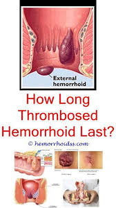 Thrombosed external hemorrhoid pictures : How To Get Rid Of External Hemorrhoids Skin Tags What Is The Best Way To Treat Howtotrea Getting Rid Of Hemorrhoids Thrombosed Hemorrhoid Hemorrhoid Remedies