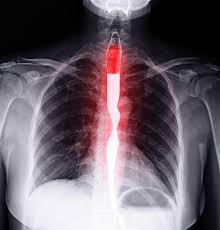 Liver cancer is the growth and spread of unhealthy cells in the liver. What Were Your First Symptoms Of Esophageal Cancer Forum