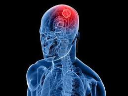 Keluar lelehan luar biasa dan berbau busuk dari faraj. Otak Tumor Gejala Pada Peringkat Awal Tanda Tanda Awal Tumor Otak