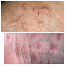 Image result for scabies on humans