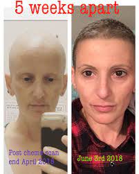 Hair loss from cancer treatment can affect people in different ways. Hair Growth After Chemotherapy Hair Mask Hair Growth After Chemo Hair Problems