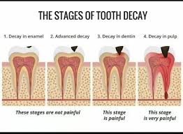 But if the cavity is between two teeth, or under a. How Long Can I Go With A Cavity Quora