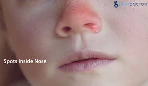 A cream, such as mupirocin, can also be used 2 to 3 times a day the doctor may need to make a small cut and drain out the pus/infection. Spots Inside Nose Nasal Vestibulitis Causes Symptoms Diagnosis And Treatment