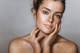 Image result for Freckled skin