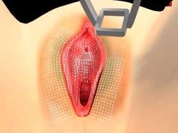 balikesir vajina beyazlatma bikini bolgesi renk acma