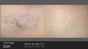 Image result for Laser Hair Reduction