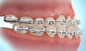 Many people live with overbites, even serious ones. How To Put Rubber Bands On Braces Premier Orthodontics