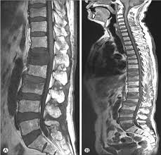 With a complicated compression fracture, not only the vertebrae but the spinal canal are injured. Ns Neurospine