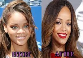 Rihanna Plastic Surgery Before After Photos Rihanna Plastic Surgery Celebrity Plastic Surgery Plastic Surgery