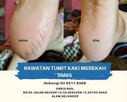 Tentunya itu sangat tidak menyenangkan karena membuat kaki jadi tidak lagi sedap untuk dipandang mata. Orkid Nail Tumit Kaki Anda Kasar Merekah Pecah Facebook