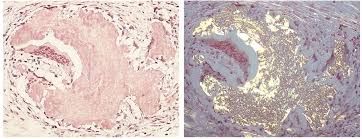 Congo red dye forms nonpolar hydrogen bonds with amyloid and red to apple green birefringence occurs when viewed by polarized light due to alignment of dye molecules on the lineraly arranged amyloid fibrils. Epos Trade