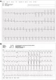 Image result for Left Bundle Branch Block
