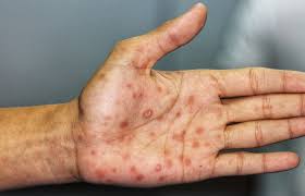 Image result for skin rash acute hiv infection