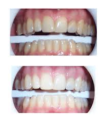 We did not find results for: Teeth Whitening Austin Texas Laser Zoom Teeth Whitening For Austin Round Rock