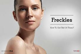 Freckles