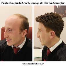 Erkek Protez Sac Modelleri Sac Dogal Sac Sac Dokulmesi
