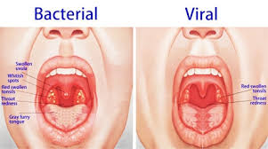 Tonsillitis Tonsillitis And Homeopathy Natural Treatment For Tonsillitis