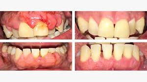But while almost 80% of adults will experience some symptoms of gingivitis, that doesn't necessarily mean it's inevitable. Osseous Surgery Purpose Benefits Procedure Pictures Alternatives
