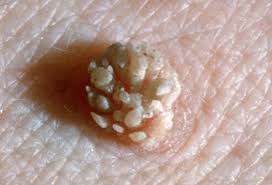 If you have hpv, you will probably get cervical cancer. Cervical Cancer Symptoms Stages And Treatment