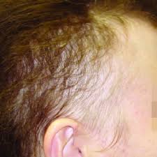 Hair follicles become irritated when something damages them. Dermoscopic Aspects In Alopecia Areata A Black Dots Circle And Download Scientific Diagram