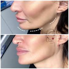 London/Lips/Fillers/Clinic (@the_botox_shop_london2) • Instagram photos and  videos