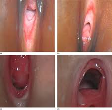 Check out our quick start guide for a more detailed guide on cup insertion just because you haven't had penetrative sexual intercourse, it doesn't mean that you're small, have an unbroken hymen or anything else. Hymen An Overview Sciencedirect Topics