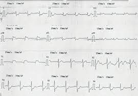 Ecg Showing Changes Consistent With Left Main Coronary Artery Disease Download Scientific Diagram