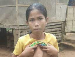 Fotos Nina De 14 Anos Tiene A Una Gemela Saliendo De Su Pecho Cooperativa Cl
