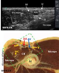 Image result for Axillary Nerve Block
